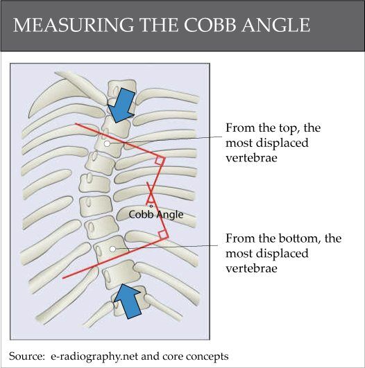 cobb角