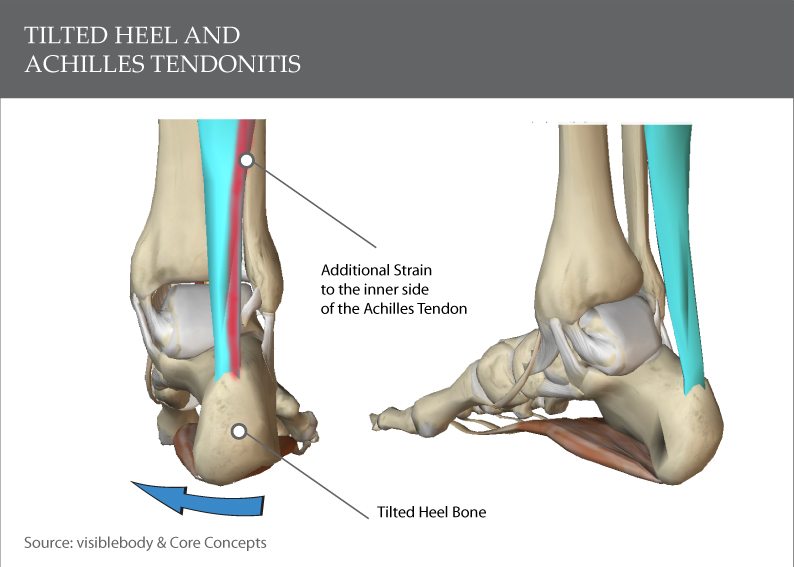 脚后跟倾斜是如何导致跟腱炎的